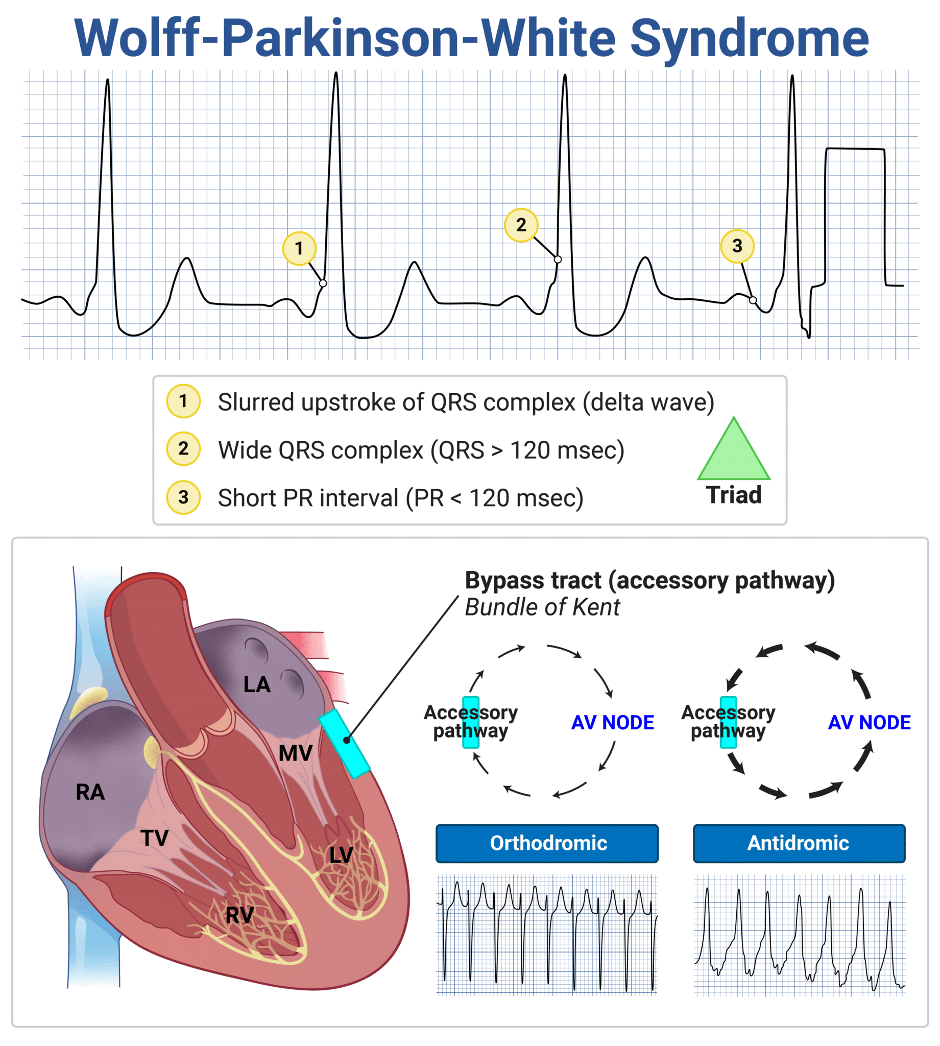 WOLFF PARKINSON WHITE WPW SYNDROME intelligence overview