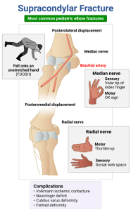 Rapid Review Supracondylar Fracture RoshReview Rapid Review Supracondylar Fracture RoshReview