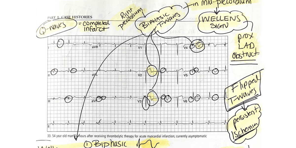 How I Learned to Read ECGs Better than a Cardiologist