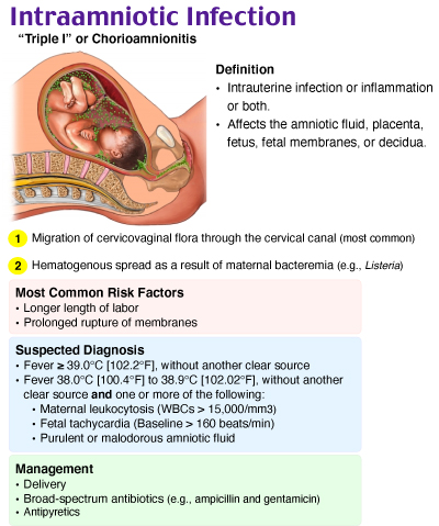 Chorioamnionitis, Intra amniotic infection, Triple I