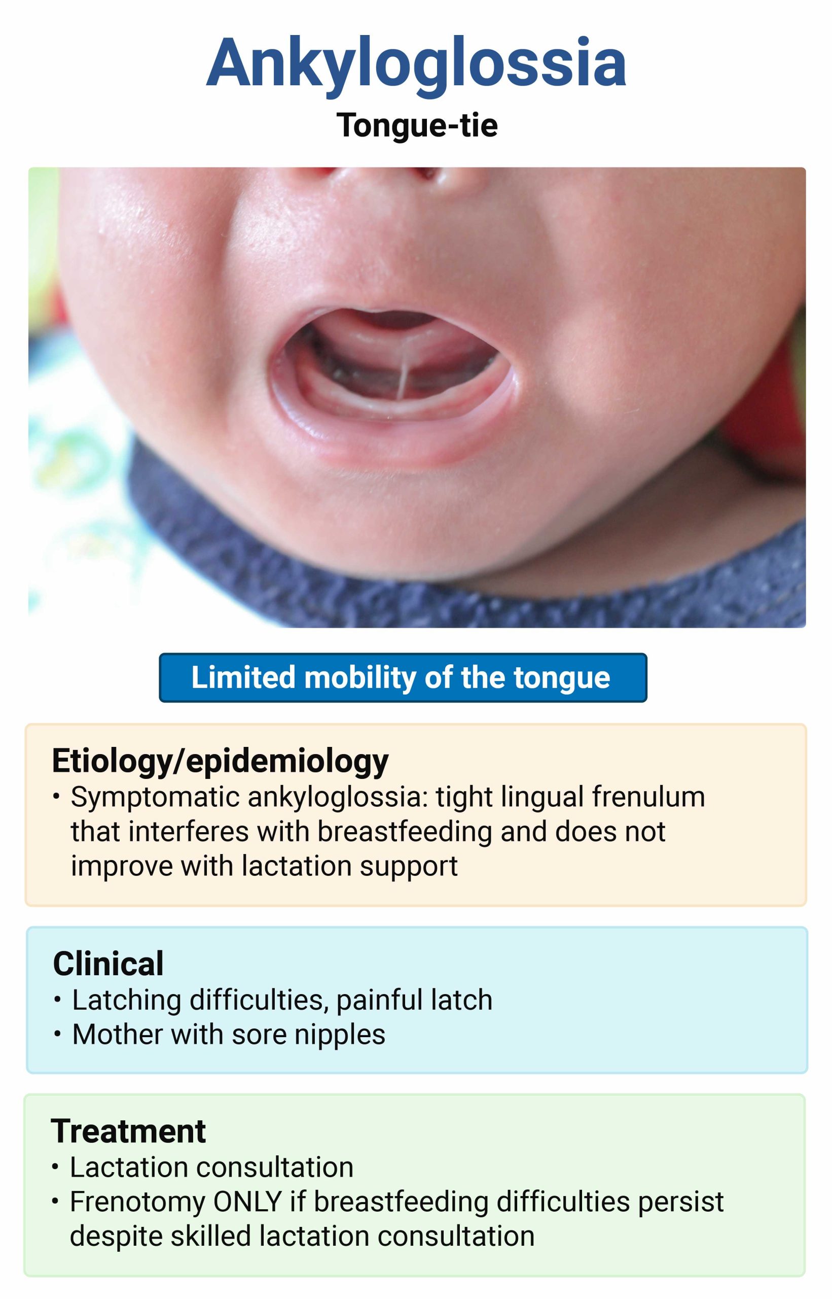 Ankyloglossia-Tongue-Tie