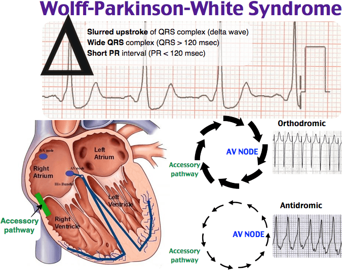 Wolff-Parkinson-White syndrome