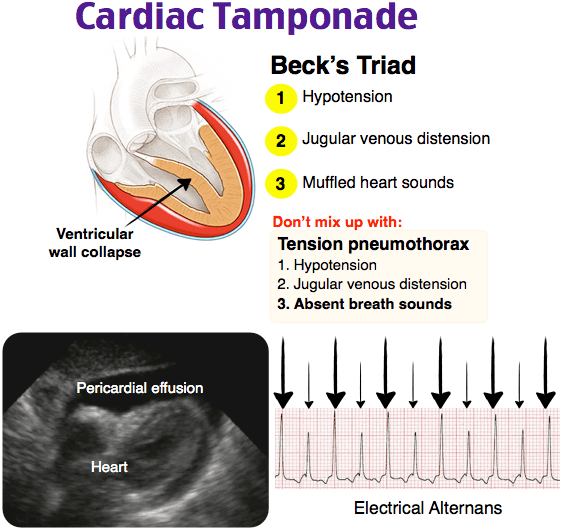 Cardiac tamponade