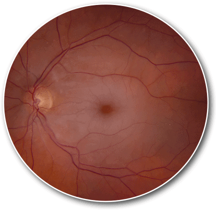 Central retinal artery occlusion 