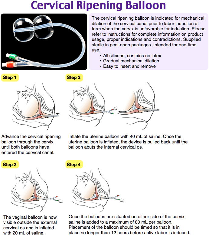 Cervical ripening balloon
