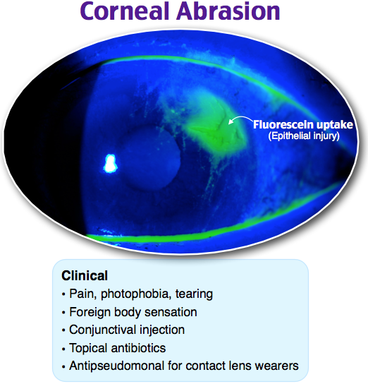 Corneal abrasion, fluorescein uptake