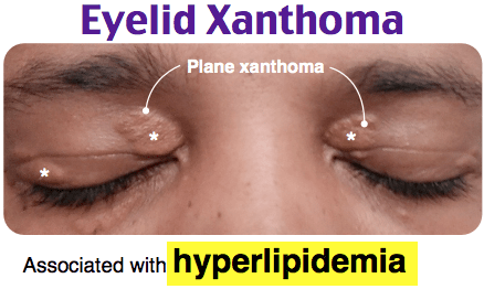 Eyelid xanthoma