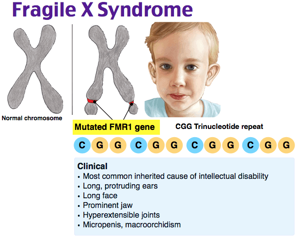 Didactic Qbank Visual Example- Fragile X Syndrome