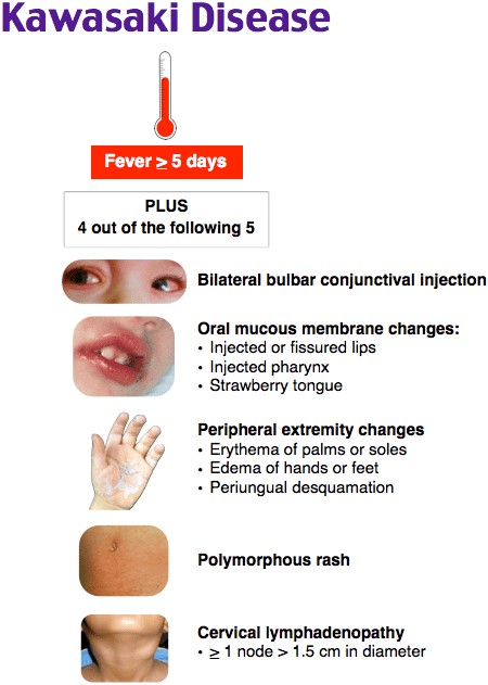 Rapid Review: Kawasaki Disease - RoshReview.com