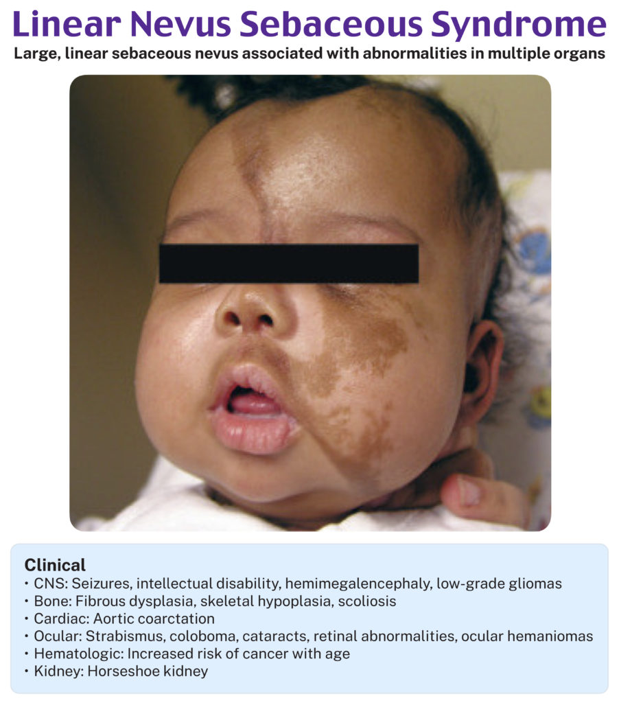 Linear nevus sebaceous syndrome