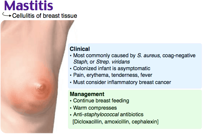Image result for mastitis