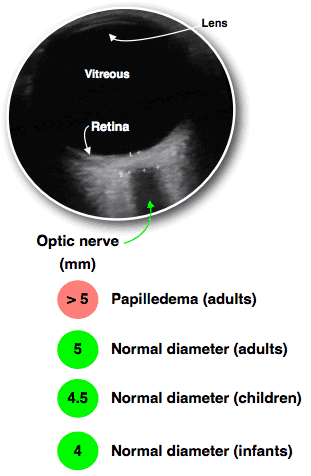 Optic nerve sheath ultrasound papilledema