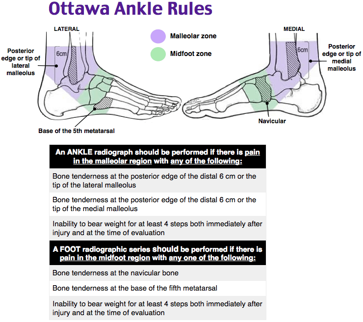 Ottawa ankle rules