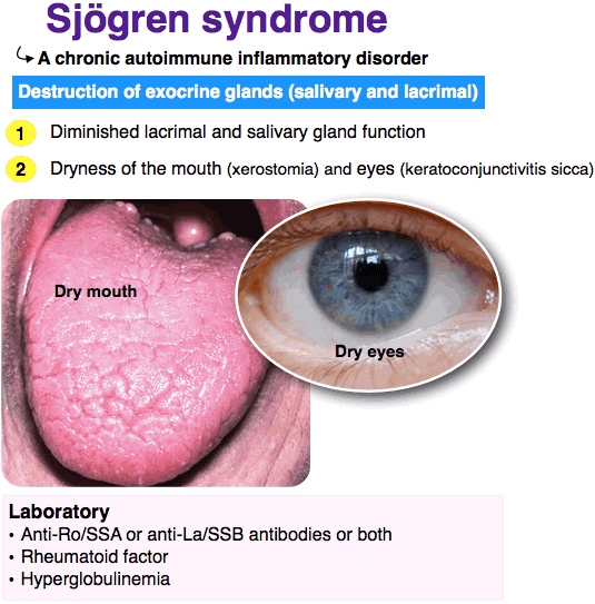 Sjogren syndrome