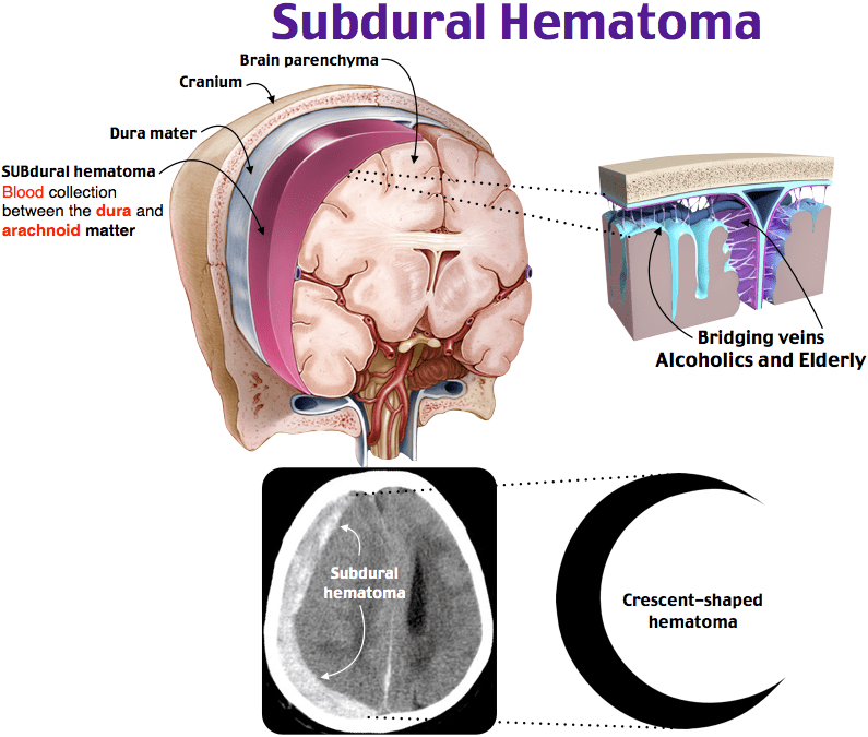 Subdural hematoma