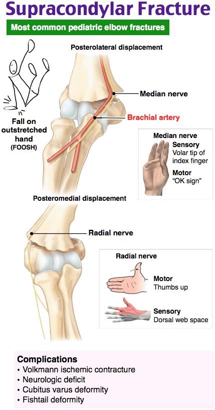 Supracondylar fracture