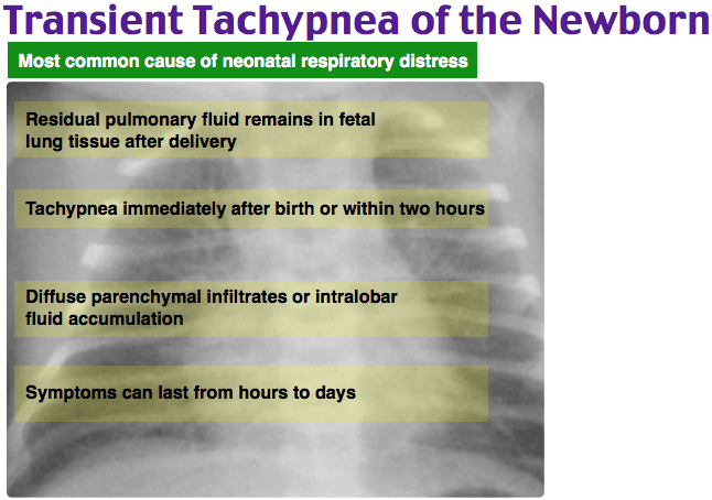 Transient tachypnea of the newborn