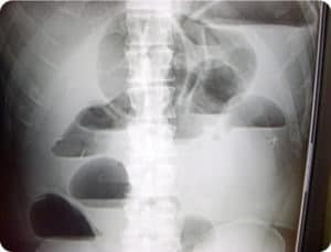 x-ray-small-bowel-obstruction